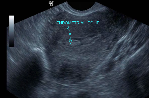 Endometrial Polip