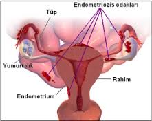 Kısırlık Sebebi Endometriozis Nedir?